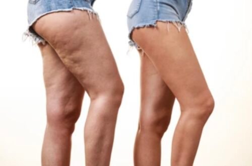 La cellulite et ses solutions