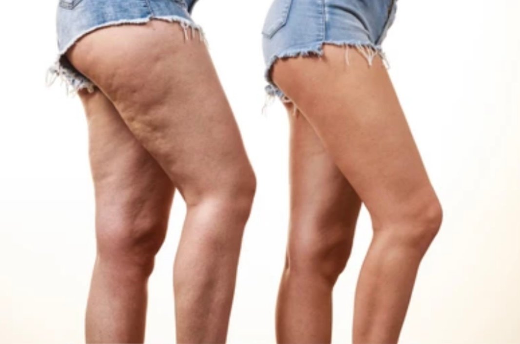 La cellulite et ses solutions